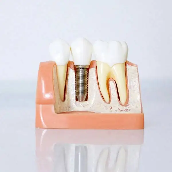 Best Dentist in Penrith | Trusted & Affordable Dental Care 17 A smiling patient receiving dental implant treatment at the best dentist in Penrith