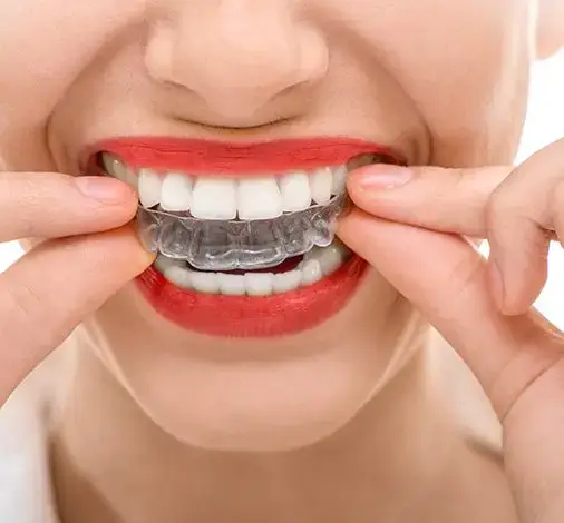 Invisalign Penrith | Clear Aligners at Penrith Dental Care 3 Invisalign clear aligner being fitted over teeth at Penrith Dental Care