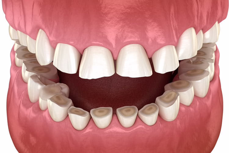 Tooth Enamel Erosion: Causes, Signs and Treatment 1 3D model showing worn front teeth