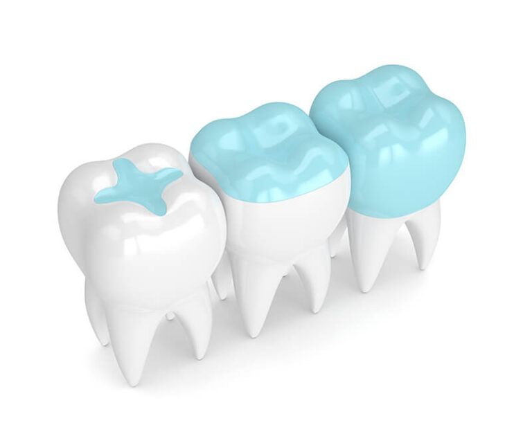 How Much Does a Tooth Filling Cost in Australia? 1 3D illustration of teeth with different types of fillings