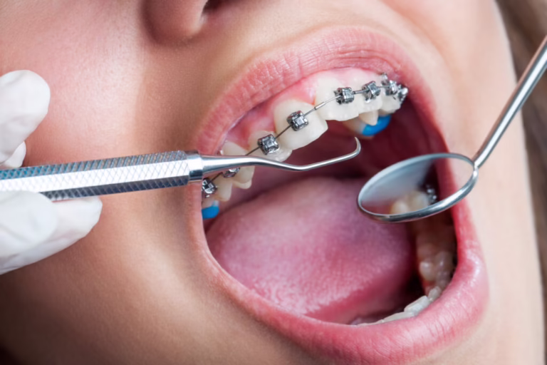 Braces for Teeth: How They Work, Types and Alternatives 1 Close-up of teeth with braces being checked with a dental mirror