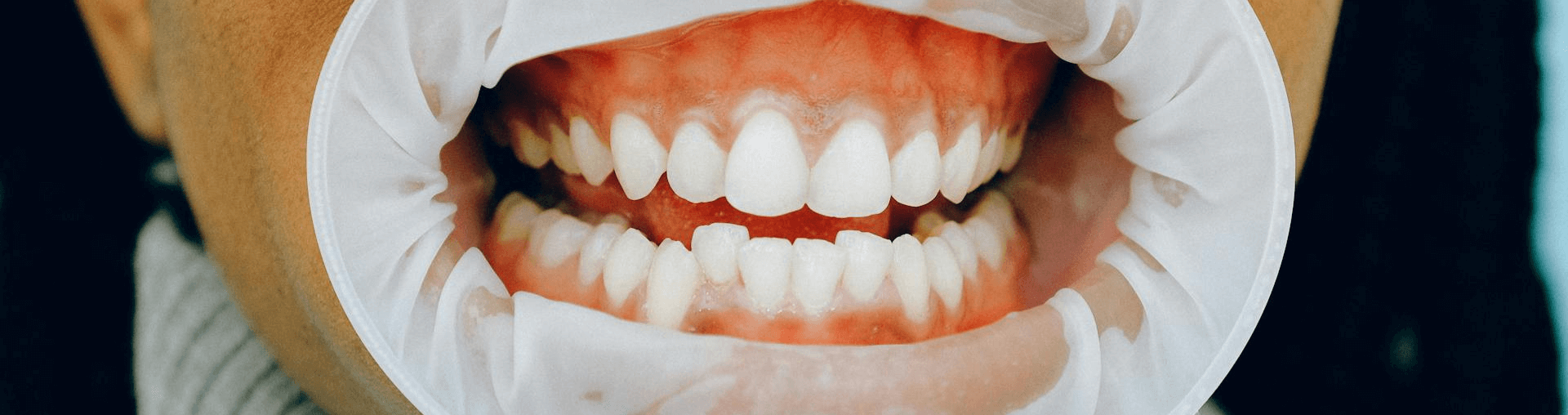 Teeth Whitening Penrith | Professional Smile Whitening Treatment 1 Brighter smile after professional teeth whitening in Penrith