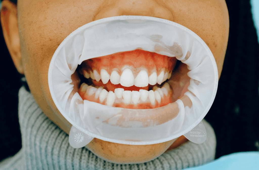 Black Triangles Between Teeth: Causes and Treatment Options 1 Close-up of teeth and gums held open with a cheek retractor