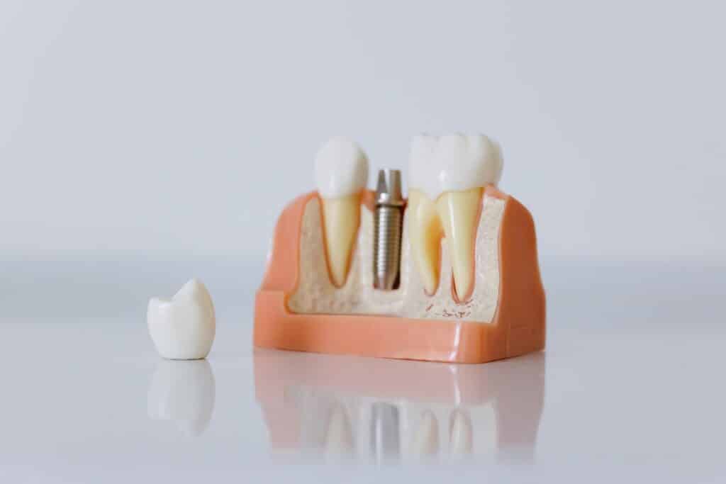 How Long Do Dental Implants Last and How Long Do They Take? 1 Model showing a dental implant between two natural teeth